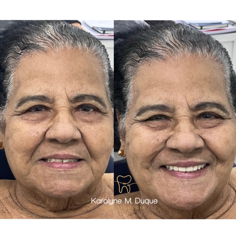 Composição com duas imagens de sorriso lado a lado, apresentada para revisão