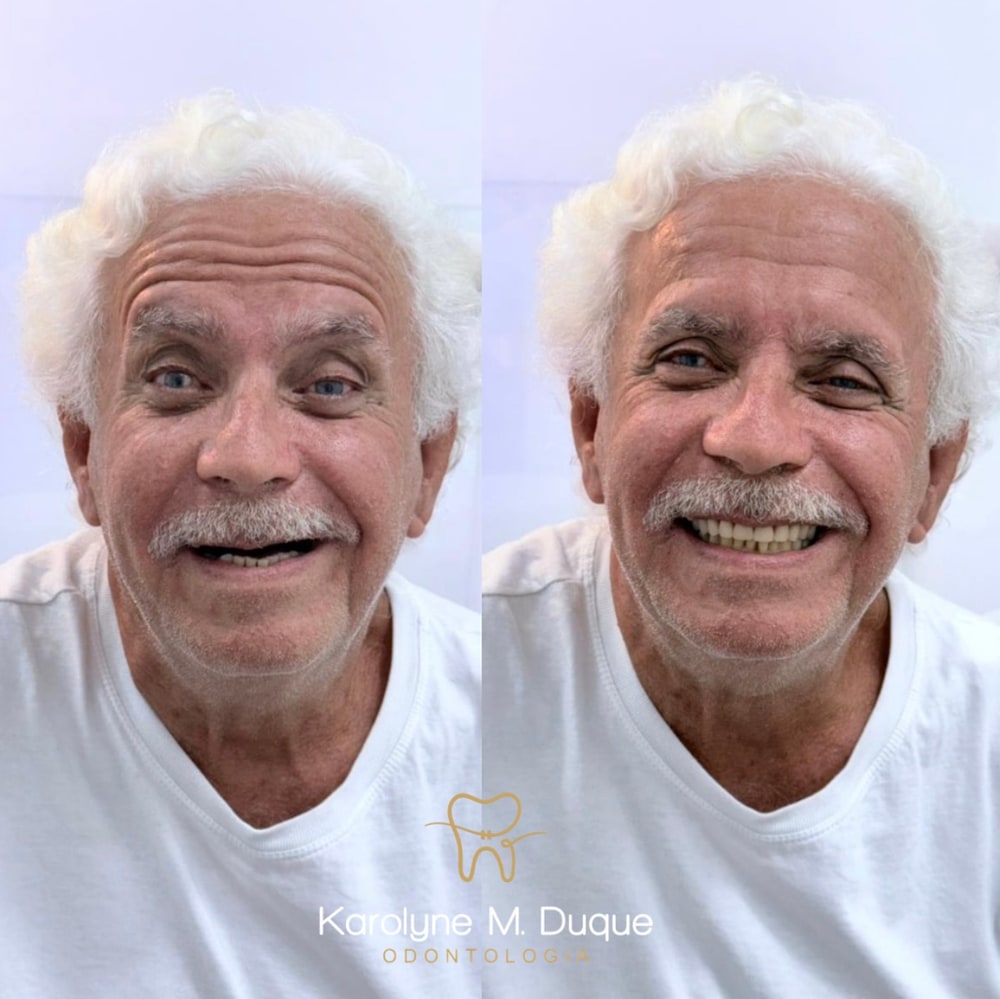 Segunda composição com duas imagens de sorriso lado a lado, apresentada para revisão